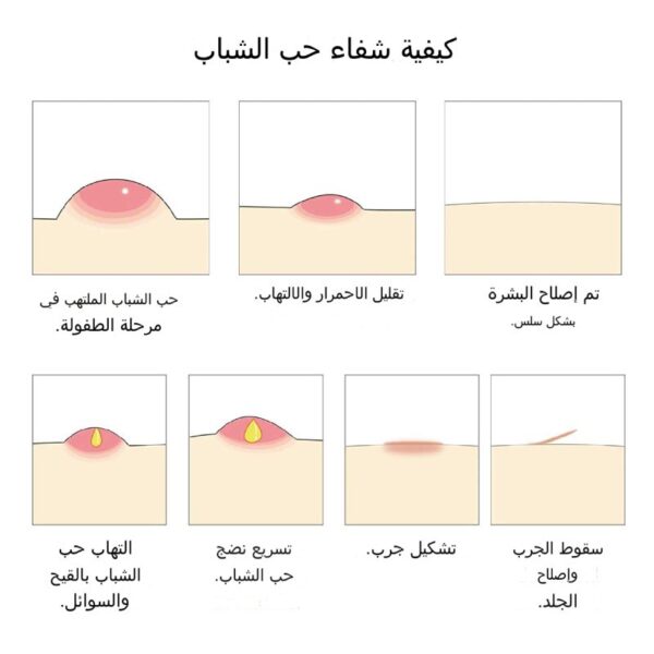 قرب زجاجة سيروم BREYLEE لعلاج حب الشباب وإزالة البثور