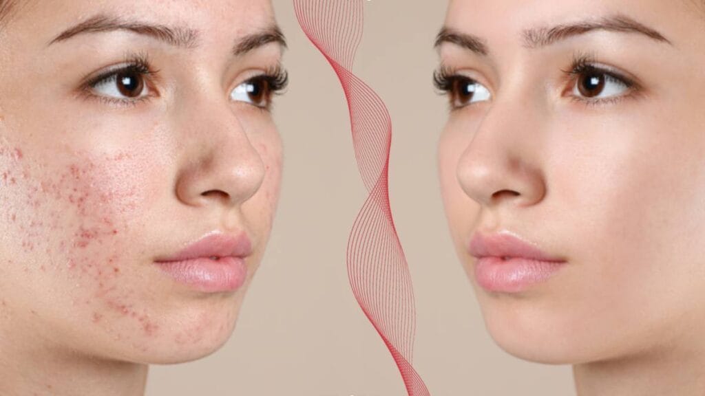 أفضل كريم لحب الشباب, كريم علاج حب الشباب, كريم لازالة البثور بسرعة,