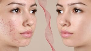 أفضل كريم لحب الشباب, كريم علاج حب الشباب, كريم لازالة البثور بسرعة,