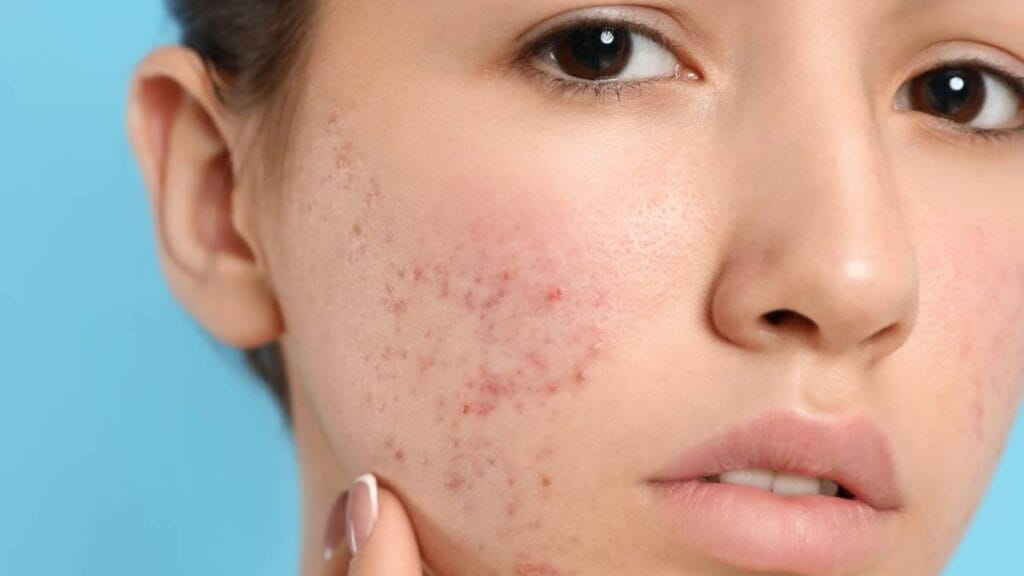 علاج حب الشباب طبيعياً بسرعة بالمنزل, علاج حب الشباب بالمنزل طرق طبيعية للتخلص من حب الشباب ماسكات لعلاج حب الشباب