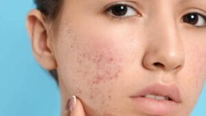 علاج حب الشباب طبيعياً بسرعة بالمنزل, علاج حب الشباب بالمنزل طرق طبيعية للتخلص من حب الشباب ماسكات لعلاج حب الشباب