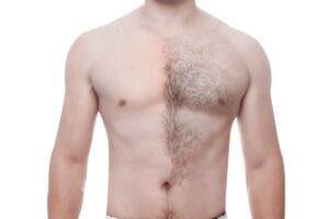 ازالة شعر الجسم للرجال