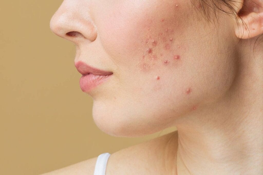 حب الشباب الهرموني