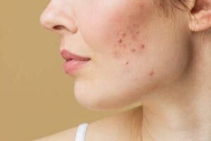 حب الشباب الهرموني