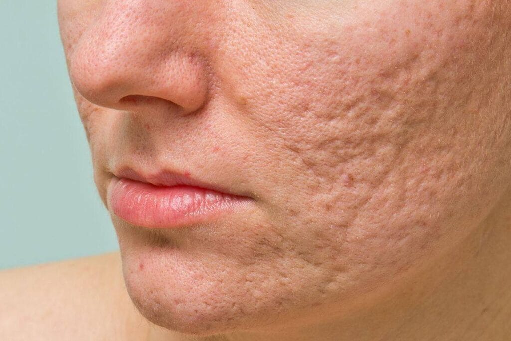 علاج ندبات حب الشباب