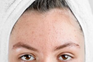 كيف أقضي على آثار حب الشباب