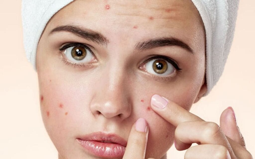 حب الشباب لدى البالغين