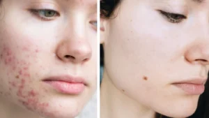 أنواع حب الشباب وأسبابه وطرق علاجه